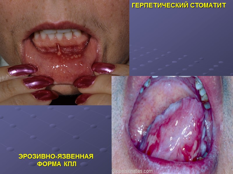 ГЕРПЕТИЧЕСКИЙ СТОМАТИТ ЭРОЗИВНО-ЯЗВЕННАЯ  ФОРМА КПЛ